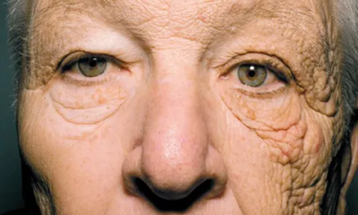 Visible aging (wrinkles and sagging)