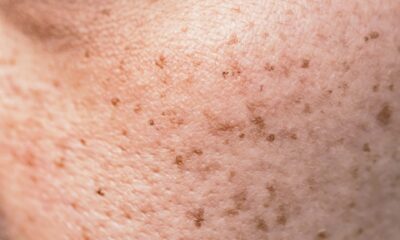 Wrinkles and sagging, dark spots and moles, enlarged pores and pigmentation
