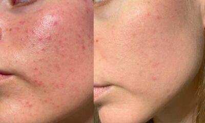 Worsening of acne, eczema, and dry skin
