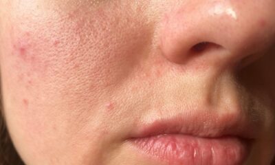 Enlarged pores and pigmentation