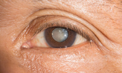 Cataracts