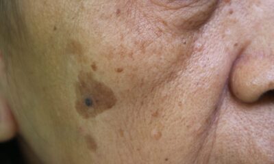 Skin cancer