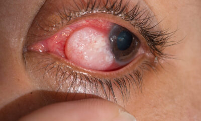 Eye tumors